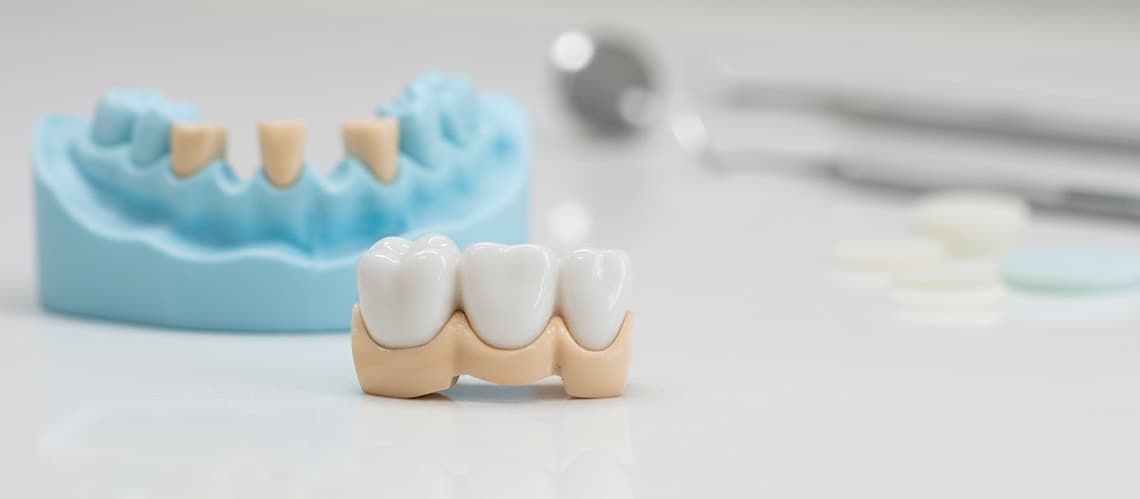 Professional Dental Bridges procedure at Philadelphia Dental - serving Broad Street, Moyamensing, Liberty Place, and 2 more Philadelphia area cities
