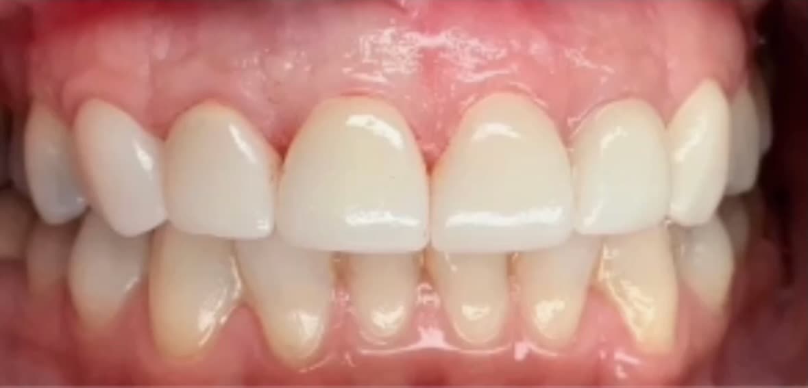 After Porcelain Dental Veneers treatment in Broad Street, Moyamensing, Liberty Place, and 2 more Philadelphia area cities - restored natural-looking tooth at Philadelphia Dental