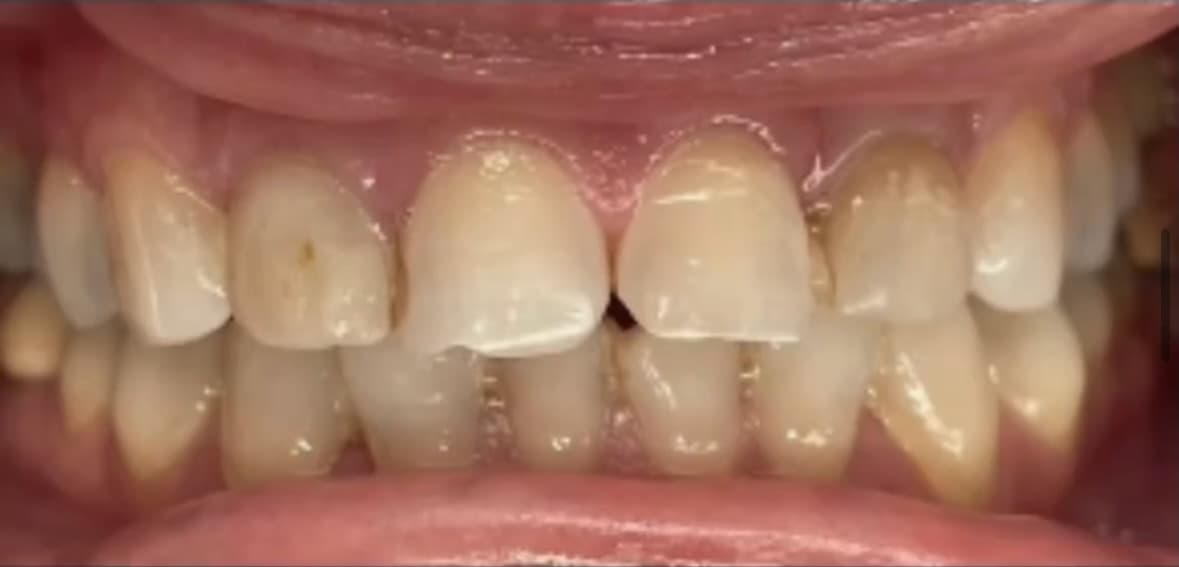 Before Porcelain Dental Veneers treatment in Broad Street, Moyamensing, Liberty Place, and 2 more Philadelphia area cities - Before Veneers